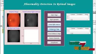 Final Year Projects | A New Supervised Method for Blood Vessel Segmentation in Retinal Images