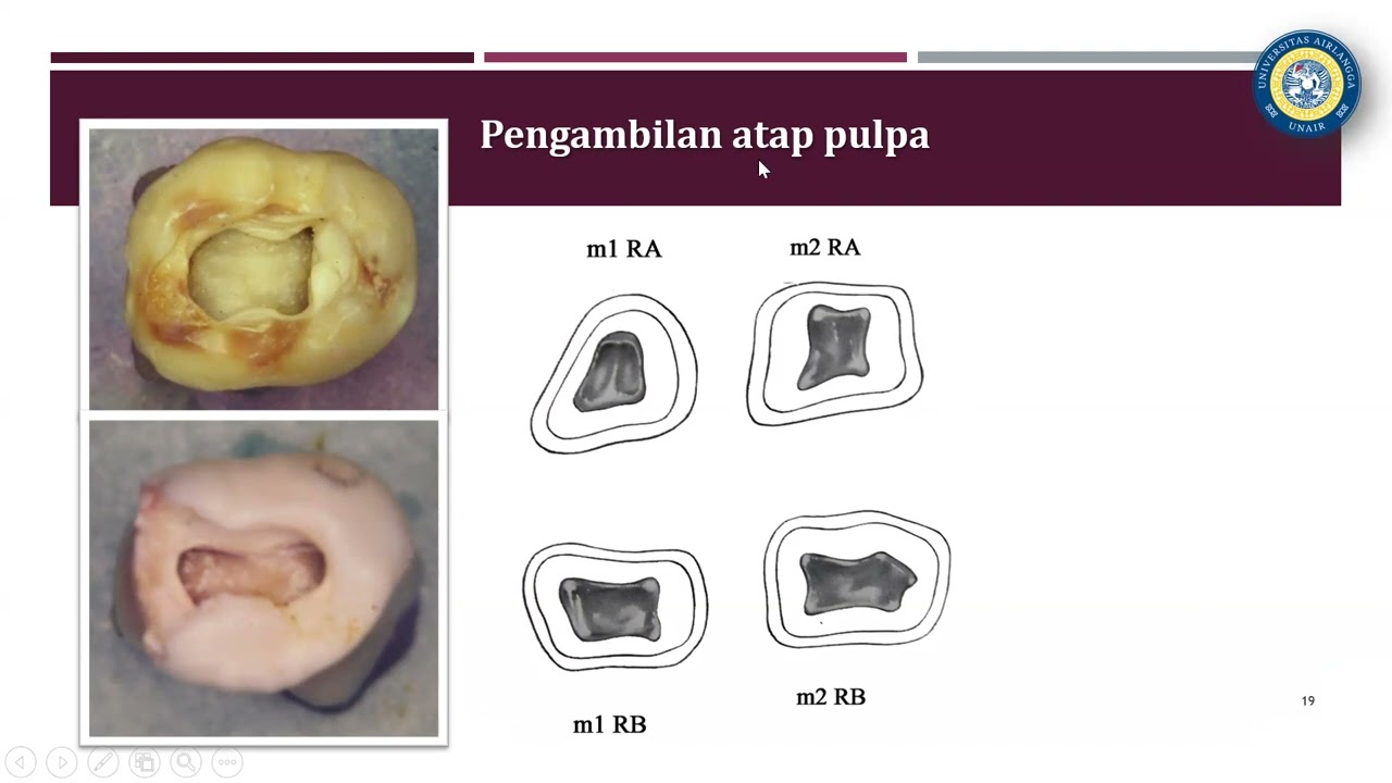 Video Kuliah IKGA2 Perawatan Pulpa Gigi Sulung 2   2 Maret 2026