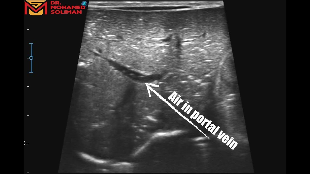 Neonatal Necrotizing Enterocolitis NEC Ultrasound Case Neonatal Necrotizing Enterocolitis NEC Ultrasound Case