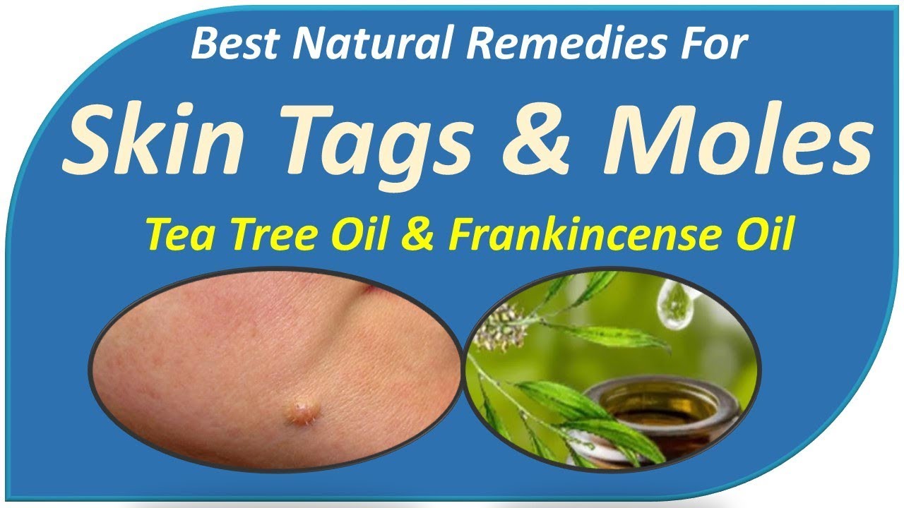 Best Natural Remedies For Skin Tags And Moles Treatment - Tea Tree Oil & Frankincense Oil