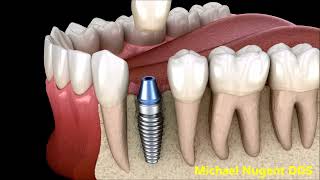 Dental Implant, Abutment and Crown | Pasadena, Texas Dentist
