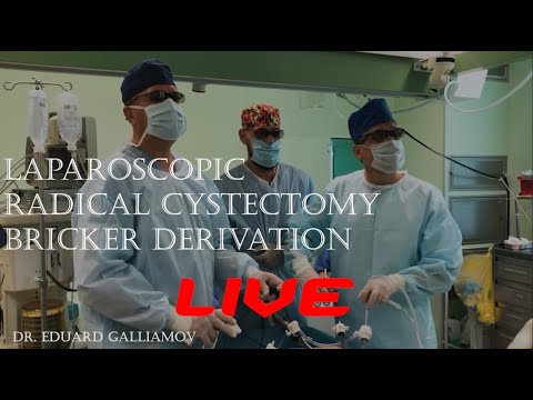 Laparoscopic Radical cystectomy Bricker derivation LIVE / Радикальная цистпростатэктомия Бриккер