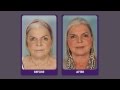 Full face lift premier image cosmetic  laser surgery patient testimonial