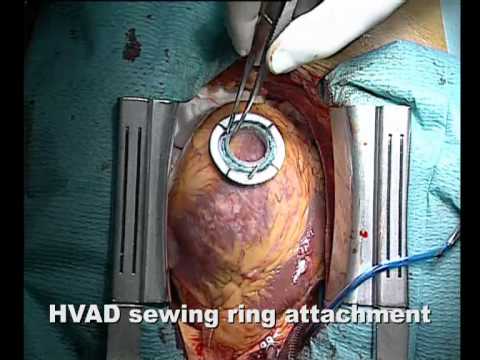 prof luigi martinelli hvad heartware implant mp4 youtube