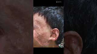 Fungal Infection Treatment My Clinic youtubeshorts skincare fungalinfection skin india