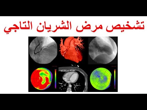 ما هي طرق تشخيص مرض الشريان التاجي؟ الفحوصات التشخيصية لضيق و انسداد الشرايين التاجية للقلب