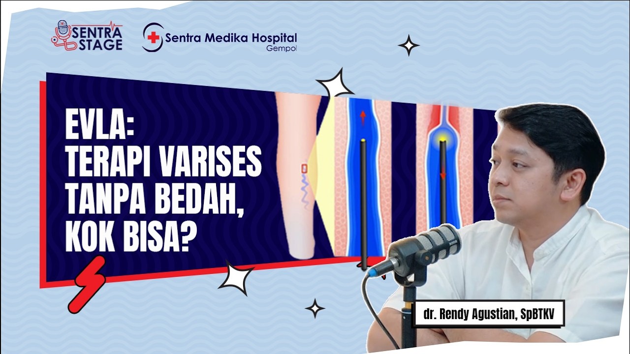 EVLA: Terapi Varises Tanpa Bedah, Kok Bisa? | Sentra Stage