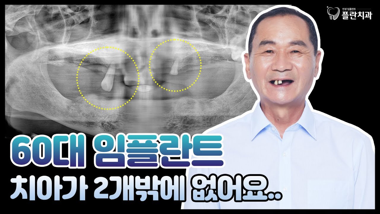 [60대 임플란트] 치아가 2개밖에 없어요...