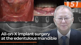 All-on-X implant surgery at the edentulous mandible