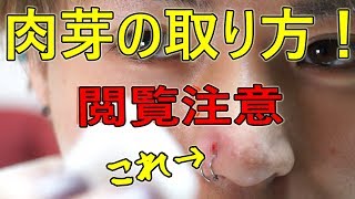 【閲覧注意】ピアスを開けるとできる"肉芽"の取り方！