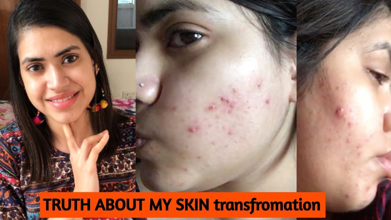 How I cleared my SKIN from ACNE & DARK SPOTS - YouTube
