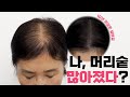 여성 탈모, 가르마 비침 고민? 두피문신이 답이 될 수 있어요