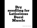 Dry needling for Latissimus Dorsi Muscle