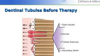 Dentinal Hypersensitivity - Perio Ch 24 Lect II