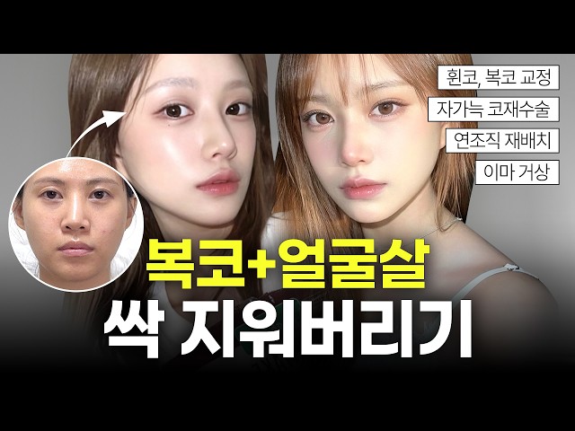 답답했던 눈매·복코·얼굴살 완벽 박멸! 4개월 만에 인상 확 바뀐 대변신 썰 털어둡니다 🎬💫