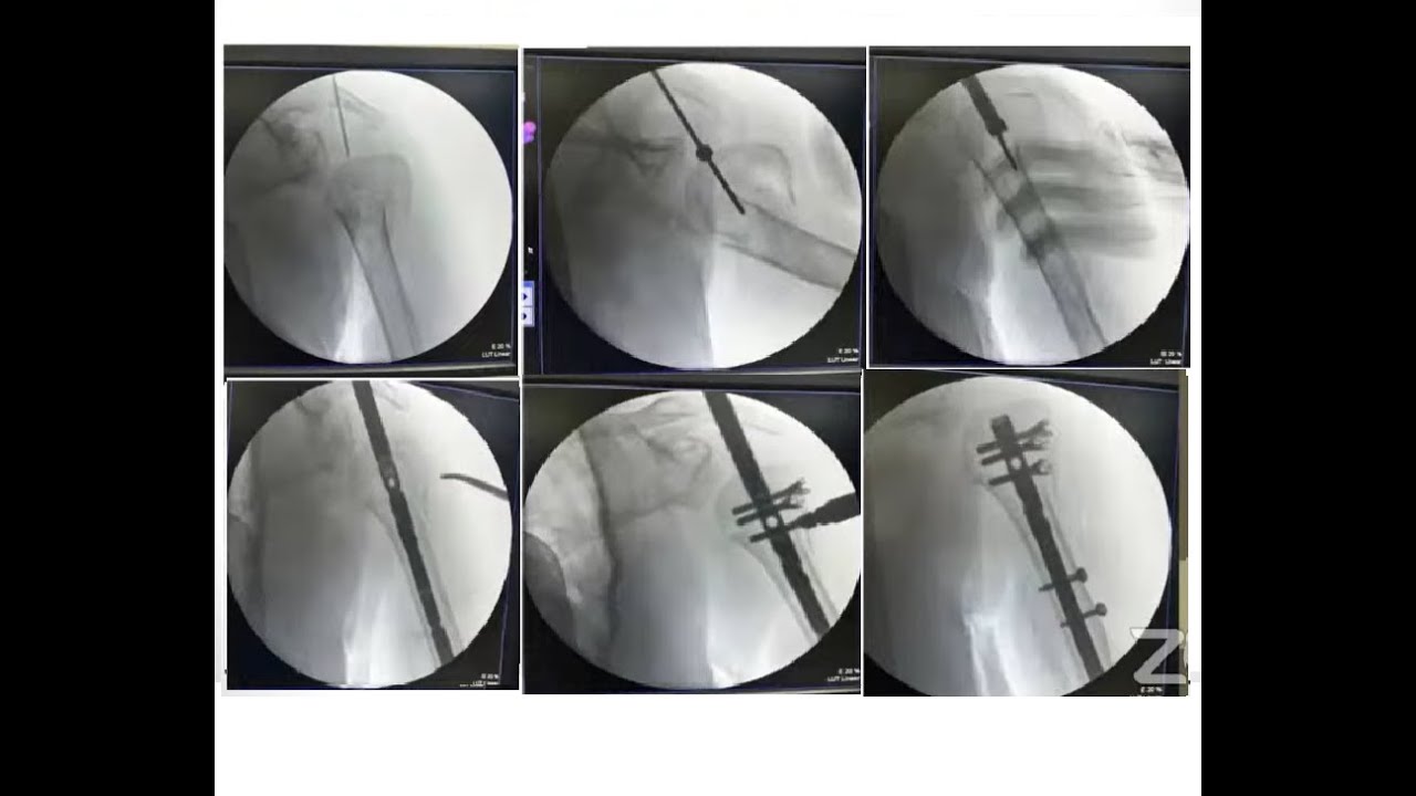 proximal humerus fx nailing - YouTube