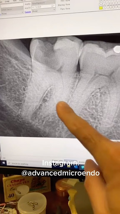 #dentists #dentalartistry #dentalcare #hygienist #dentist #apexdental #dentalprocedure #rootcanal