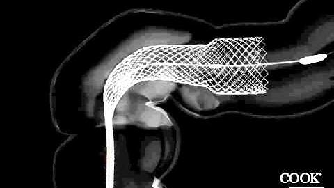 Evolution® Colonic Controlled-Release Stent - Uncovered Fluoroscopic Animation
