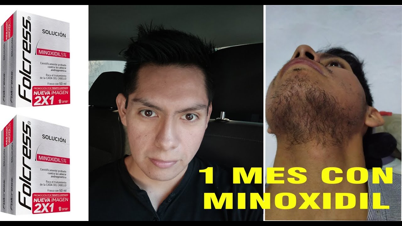 MINOXIDIL 1 MES - YouTube