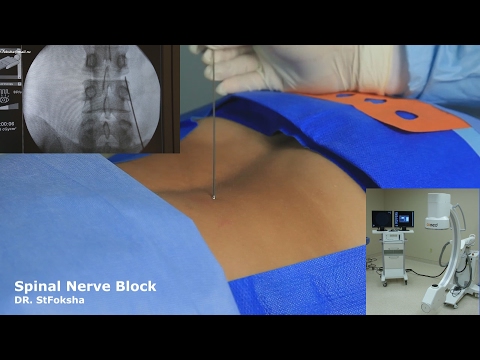 Блокада Позвоночника под Контролем | Spinal Nerve Block