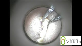 耳掃除 Vol 16 つながった耳垢 ピンセット出動 Ear Wax Removal イヤーエステサロンvillalo ヴィラロ Youtube 耳掃除 Vol 16 つながった耳垢 ピンセット出動 Ear Wax Removal イヤーエステサロンvillalo ヴィラロ Youtube