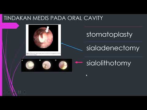 Video: Kapan miotomi digunakan?