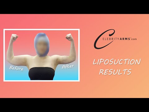 lipo c results Arm Liposuction | Immediate Results | Celebrity Arms™ | Lipo 360° | Expert  Dr. Thomas Su