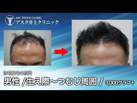 男性 生え際～つむじ周囲 3,000グラフト 　薄毛治療　自毛植毛アスク井上クリニック症例