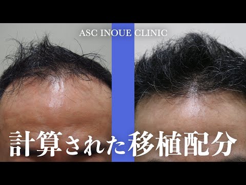 男性 生え際 つむじ周囲 3 000グラフト 薄毛治療 自毛植毛アスク井上クリニック症例 Youtube