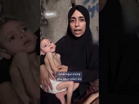 معاناة نازحة يمنية وأطفالها من الإعاقة وسوء التغذية