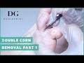 Corn Removal with callus - Double corn Part 1 (Right Foot)