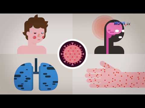 Видео: Морбили - симптоми, ваксинации, лечение на болестта