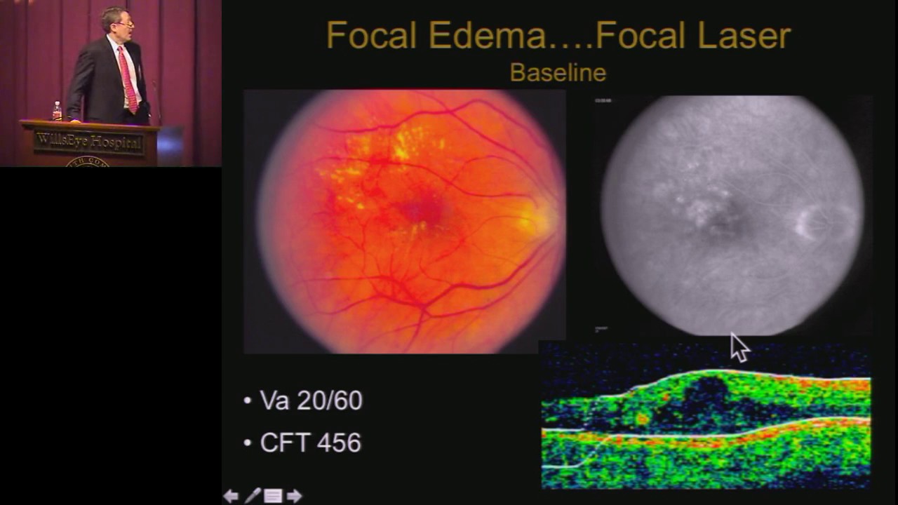 Diabetic Macular Edema CME - youtube