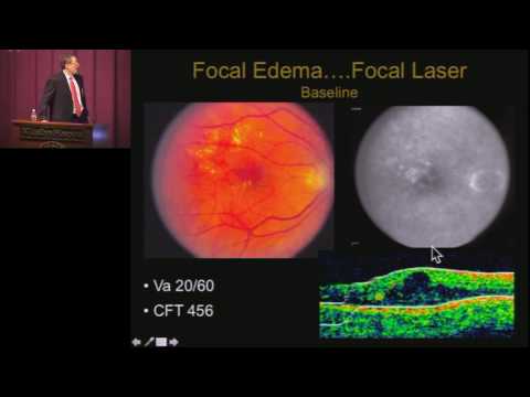 Video Diabetic Macular Edema CME - youtube