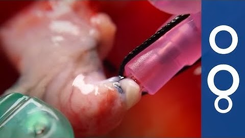 From pig gut to 3D printing - the fascinating science behind tailor-made bones