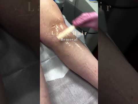 Laser Hair Removal Treatment