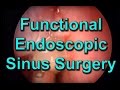 How is Functional Endoscopic Sinus Surgery Performed?