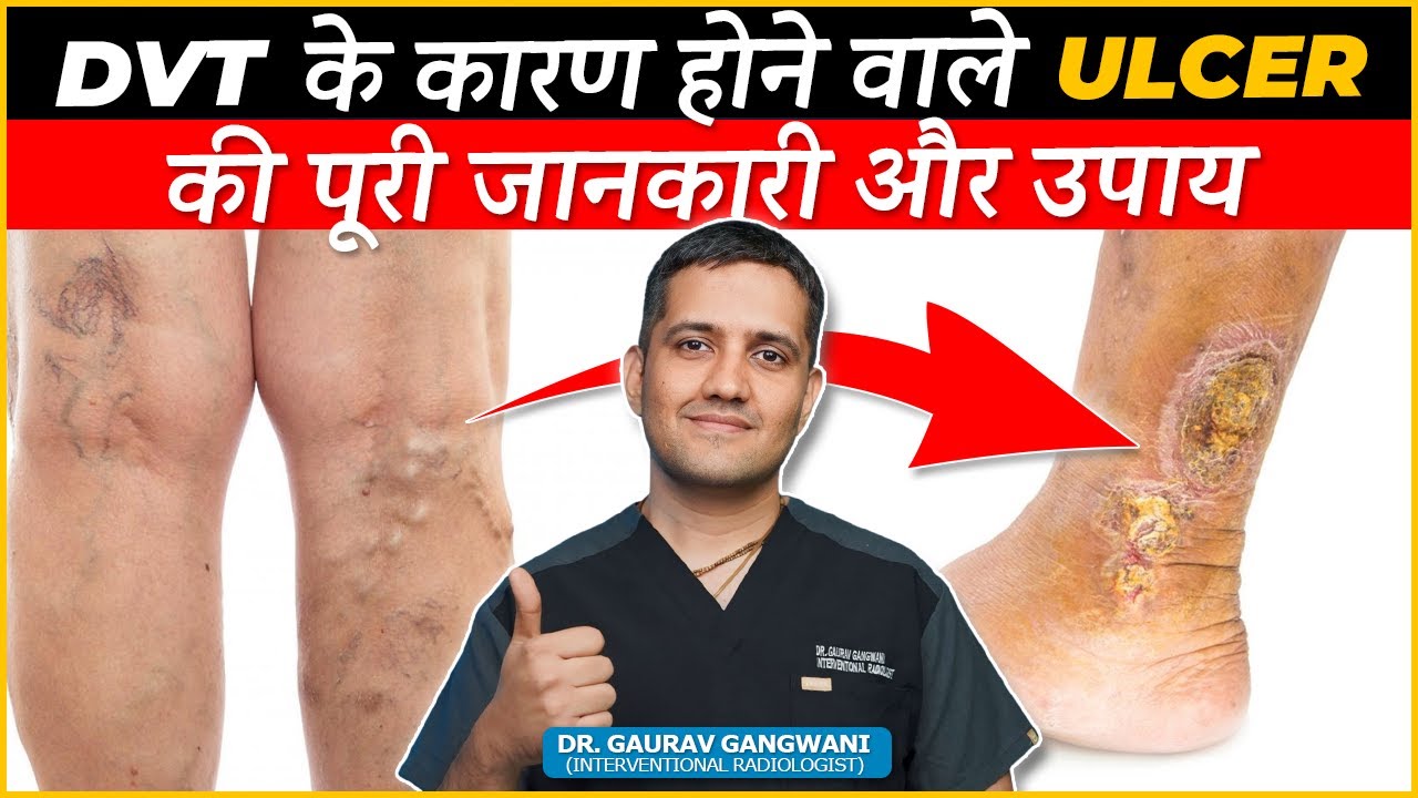 Best ways of Care and Cure for Ulcers after DVT | Dr. Gaurav Gangwani (Interventional Radiologist)