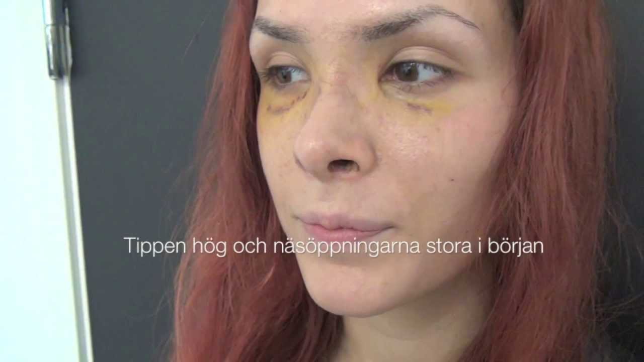 Näsplastik # 41 efter 1 vecka Rhinoplasty Primakliniken
