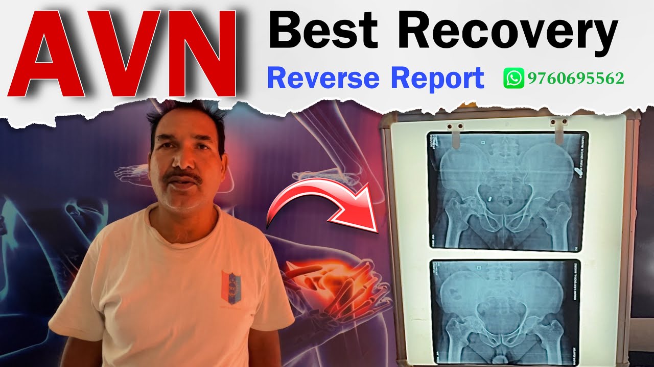 2 महीने मैं AVN ठीक हो गया 🔥 | Best Recovery Of AVASCULAR NECROSIS ( AVN ) | Dr.Amit Bharti Dehradun