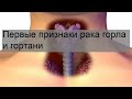 Первые признаки рака горла и гортани