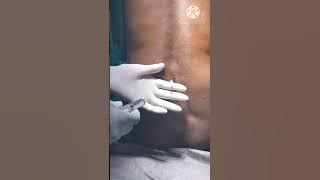How to give spinal Anesthesia?  💉