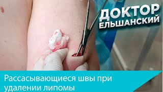 Рассасывающиеся косметические швы при удалении липом