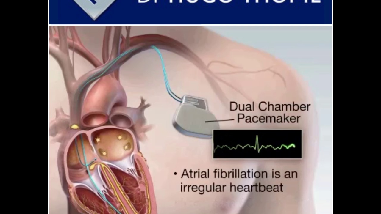 O Nodo Sinoatrial é Normalmente O Marcapasso Cardíaco Porque