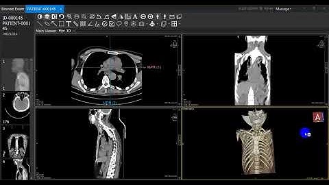 The 3D Multiplanar reconstruction (MPR)