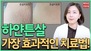 절대 피해야할 튼살치료법! 최신 하얀튼살 치료법! 튼살치료전에 꼭 봐야할 영상