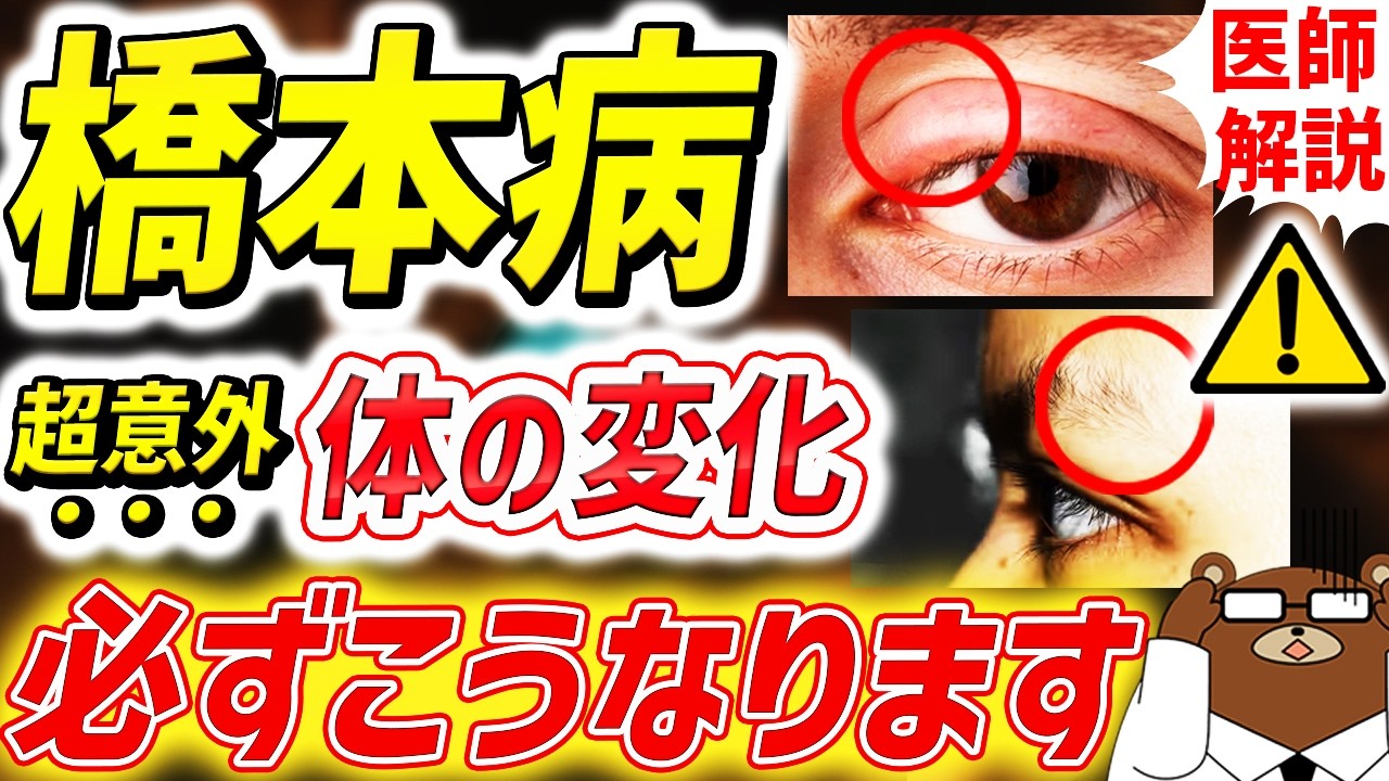むくみ・便秘・だるさ..知らないと必ず損する「女性の10人に1人がなる」橋本病の意外な初期症状。甲状腺の機能はなぜ低下するのか。うつ病になる？食べ過ぎてはいけない食べ物とは。医師が完全解説。