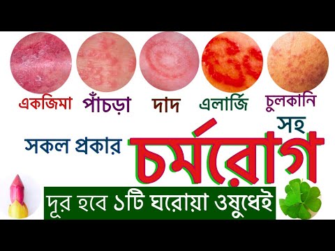 ভিডিও: কিভাবে স্ক্যাবিস নিরাময় করবেন: 15 টি ধাপ (ছবি সহ)