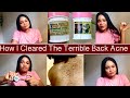 How I cleared my back acne