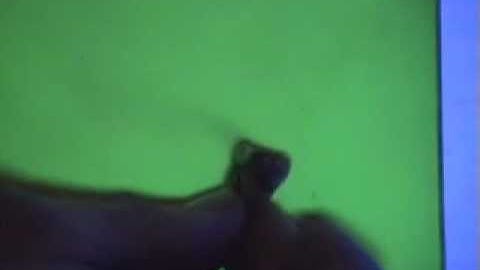 Smoking Tooth Shows Danger of Mercury Fillings